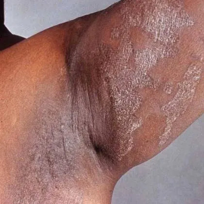 Antifungal Care