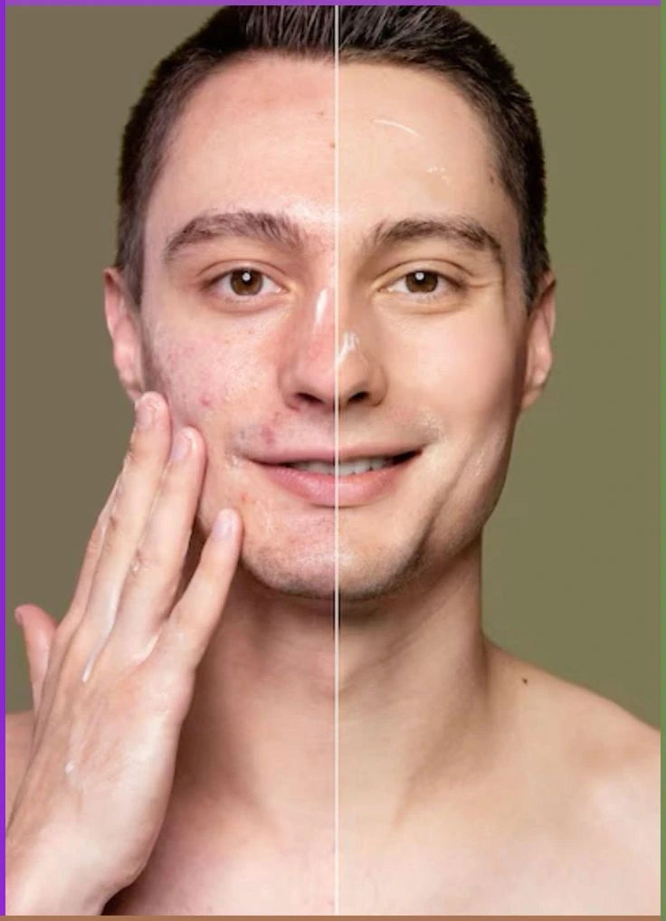 Cure for acne and skin