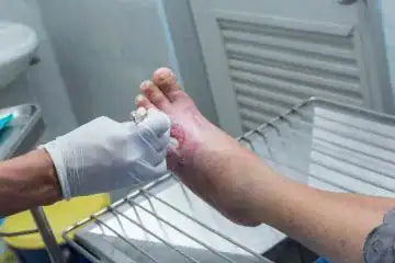 dry wounds