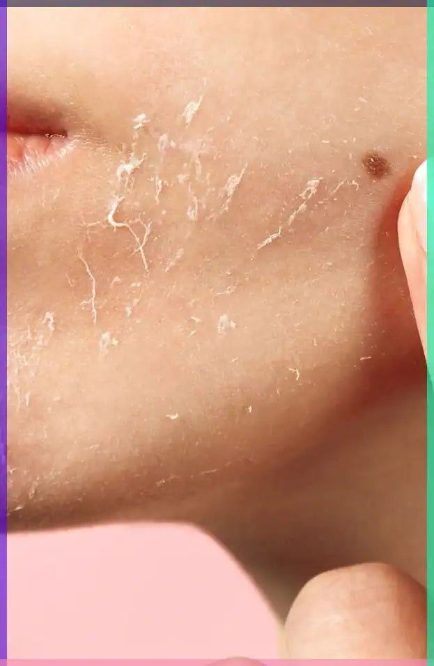 Acne UV & Protective Gels