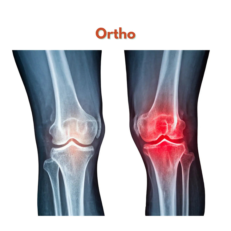 orthopaedic bone graft
