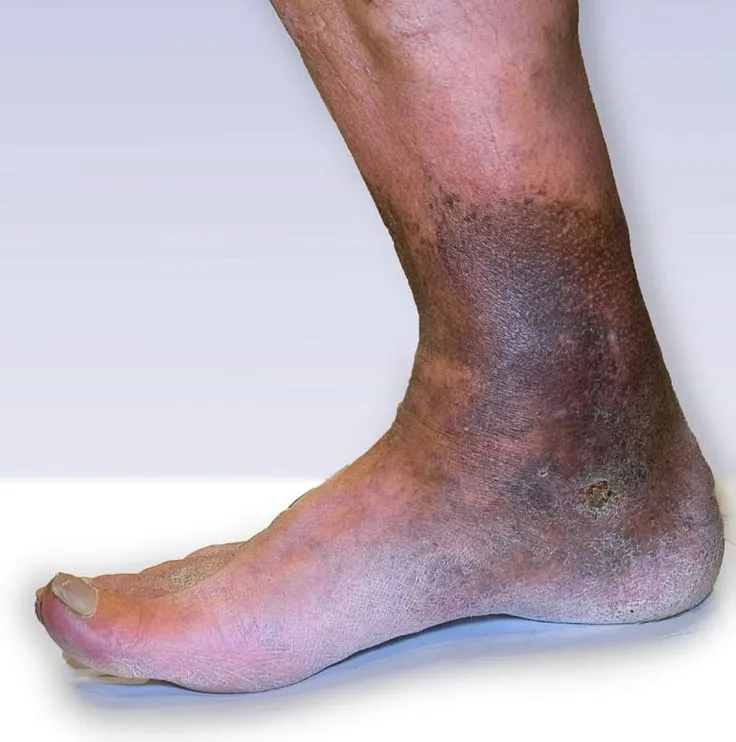 Venous stasis ulcers